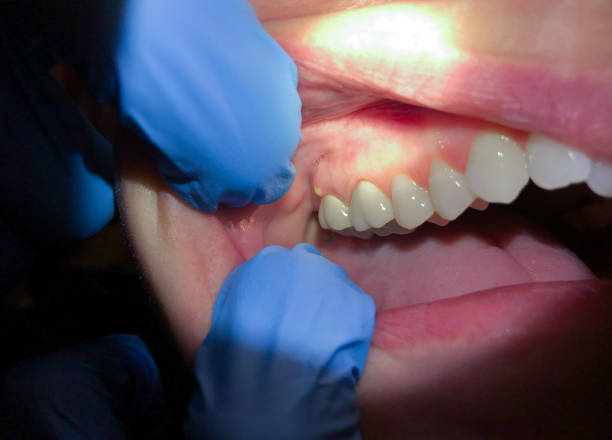Best Emergency Dental Care for Sports Injuries in Barrett, TX