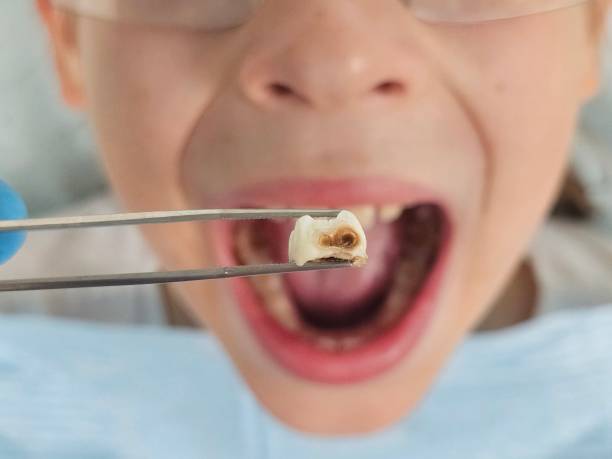 Best Emergency Wisdom Tooth Extraction in Barrett, TX